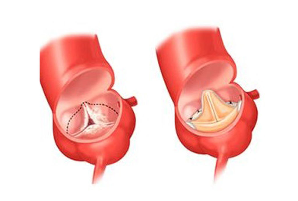 Как клапан делает операция. Митральный клапан макропрепарат. Операция на сердце аортальный клапан. Эндопротезирование аортального клапана. Аортальный клапан макропрепарат.