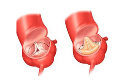 Ersatz der Aortenklappe durch eine Prothese