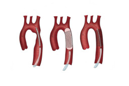 Implantation eines Stents in der Aorta