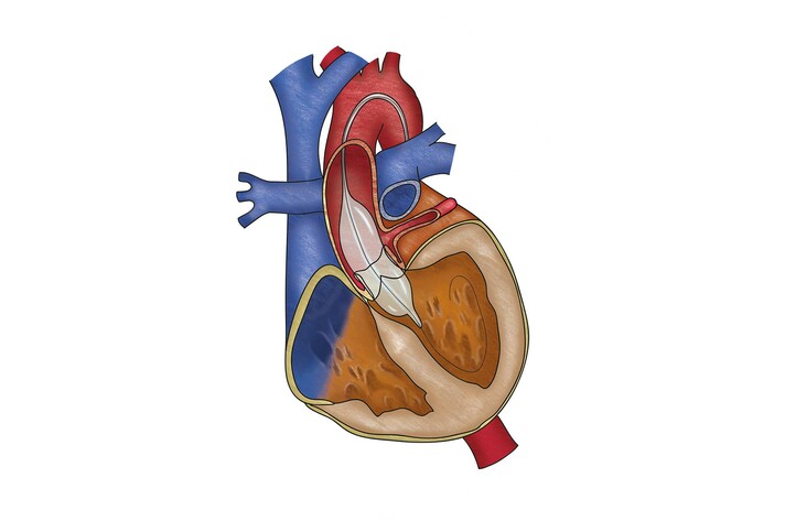 Aortenklappendilatation mit einem Ballonkatheter
